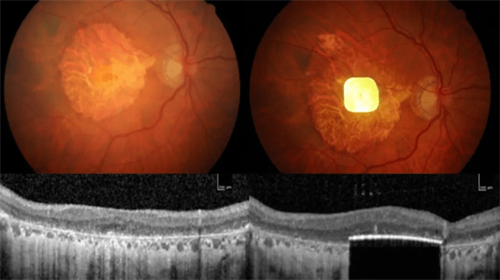 Возрастная макулярная дегенерация 